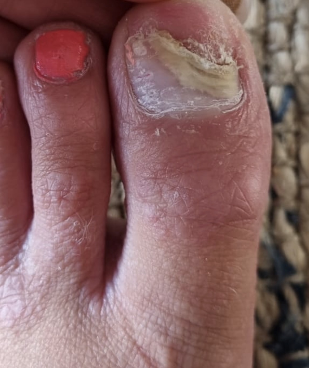 Why Does My Toenail Look Like This After an Injury?