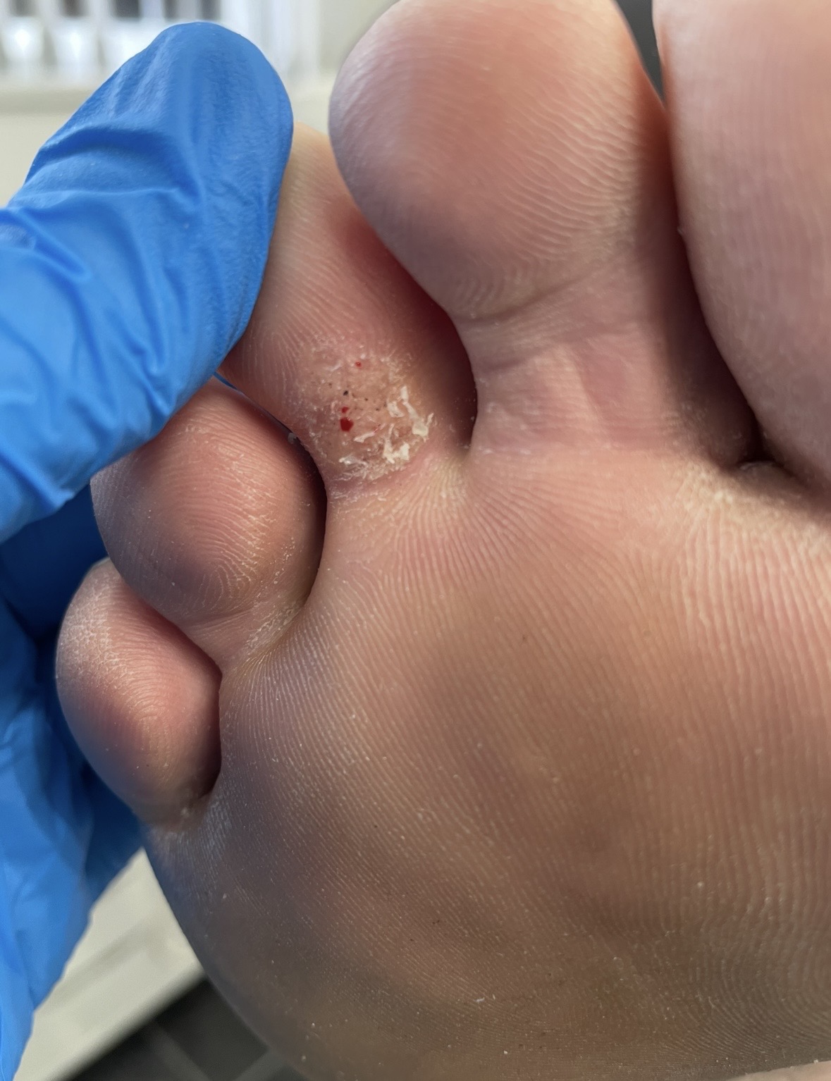 Verruca in Needling: A Treatment for Persistent Verrucae